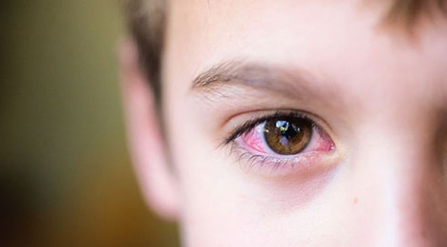 Trẻ bị thiếu vitamin A dễ mắc bệnh khô mắt